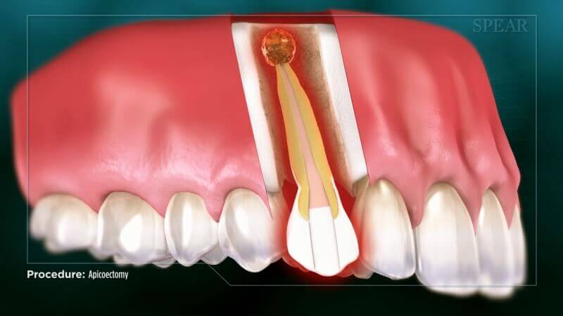 Apicoectomy