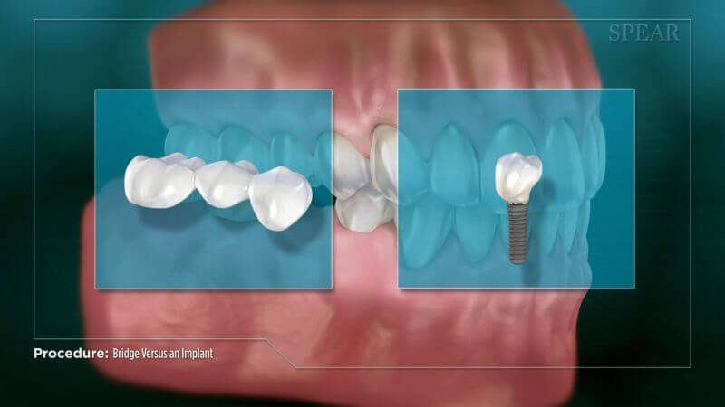 Bridge Versus an Implant