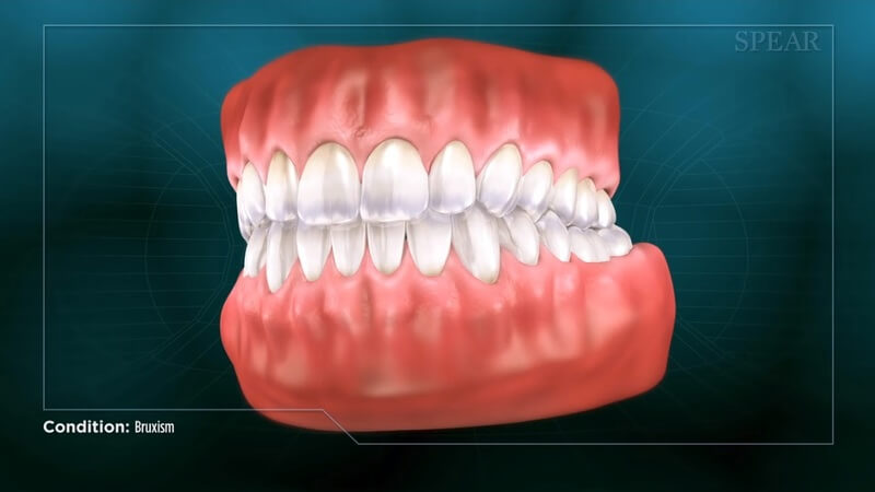 Bruxism