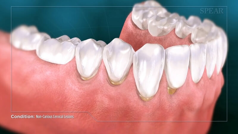 Cervical Lesion