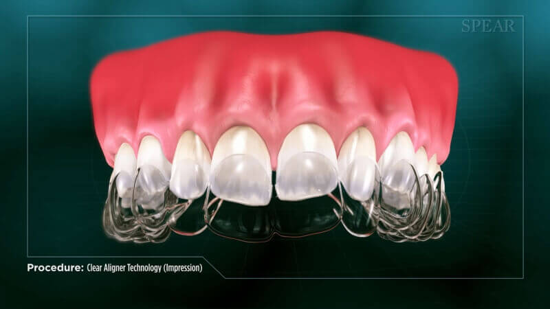 Clear Aligner Technology