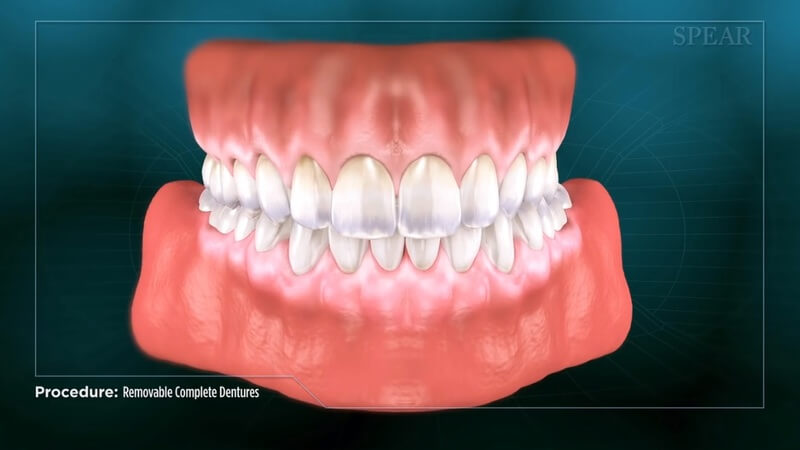 Complete Denture