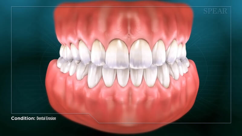 Dental Erosion