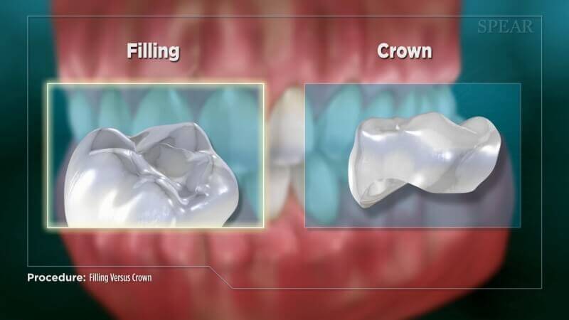 Filling Versus Crown (Impression)