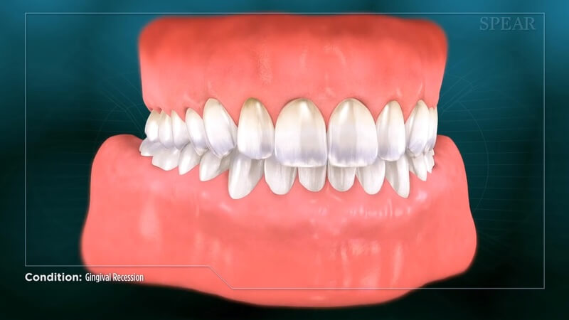 Gingival Recession