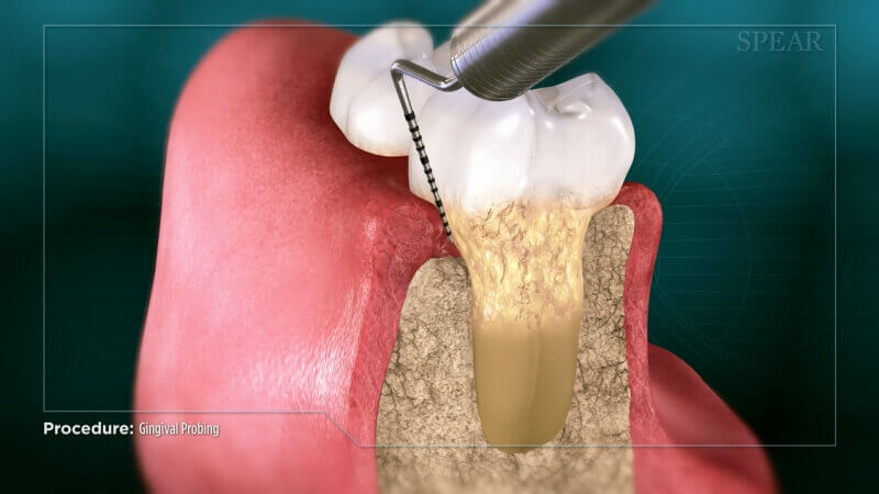 Gingival Probing & Pocket Depth