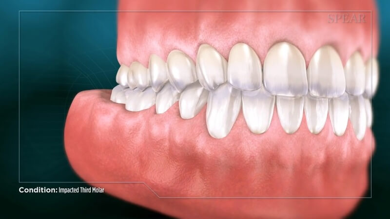 Impacted Tooth