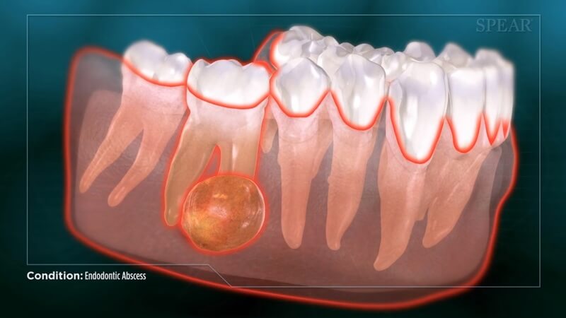 Infection/Abscess