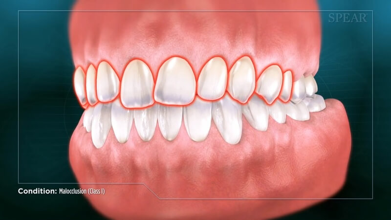 Malocclusion (Class I)