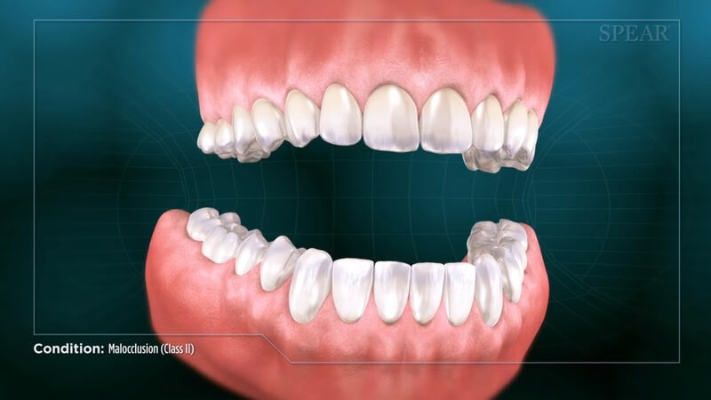 Malocclusion (Class II)