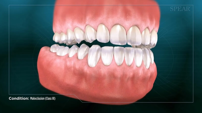 Malocclusion (Class III)