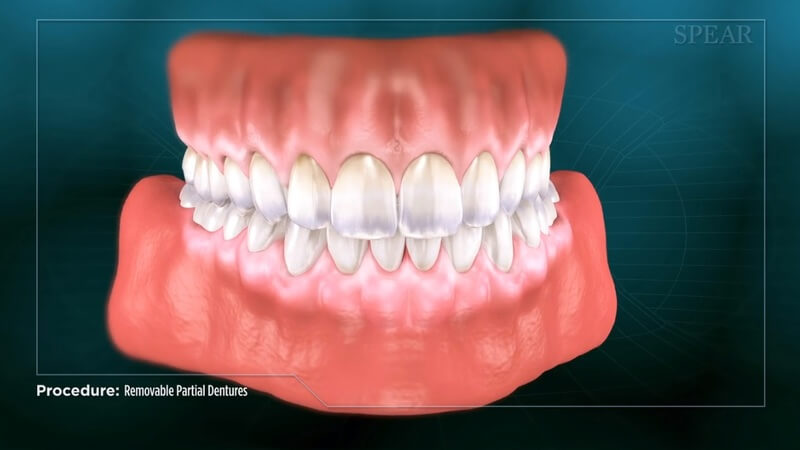 Partial Denture