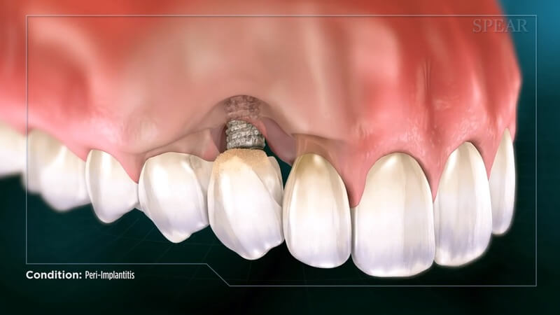 Peri-Implantitis