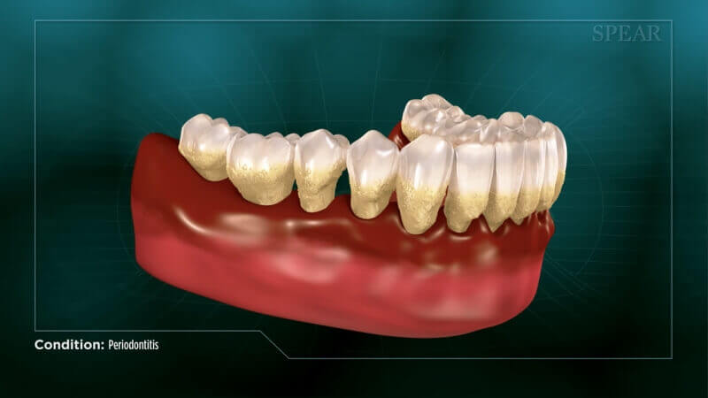 Periodontitis