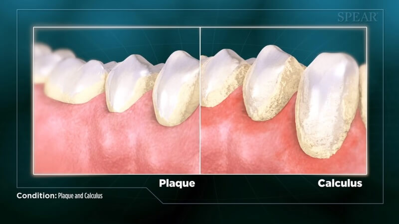 Plaque and Calculus