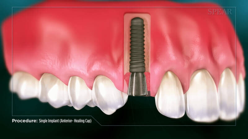 Single Implant (Anterior Healing Cap)