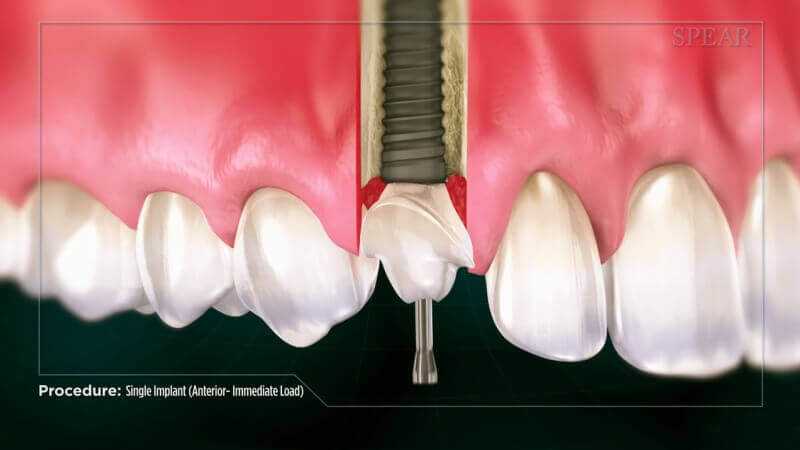 Single Implant (Anterior Immediate Load)