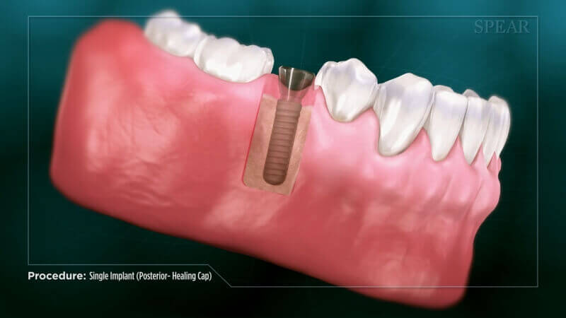 Single Implant (Posterior Healing Cap)