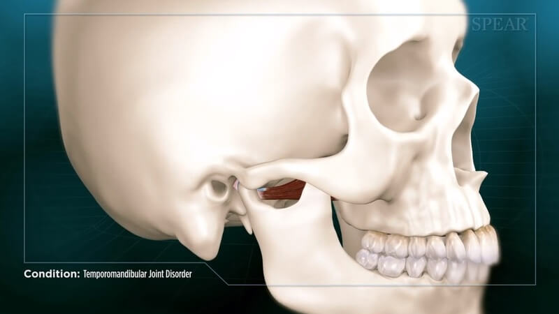 Temporomandibular Joint Disorder (TMD)