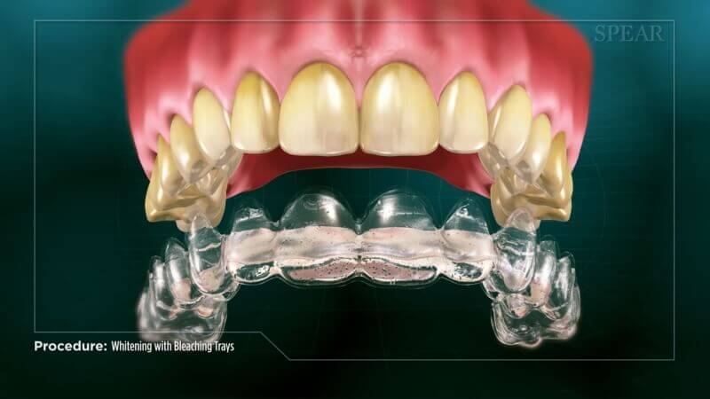 Whitening with Bleaching Tray